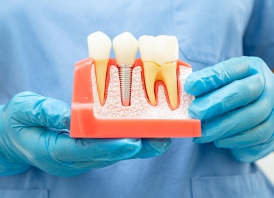 Implant Treatment